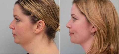 02-tratamento-papada-antes-depois