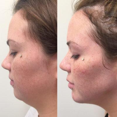 03-tratamento-papada-antes-depois