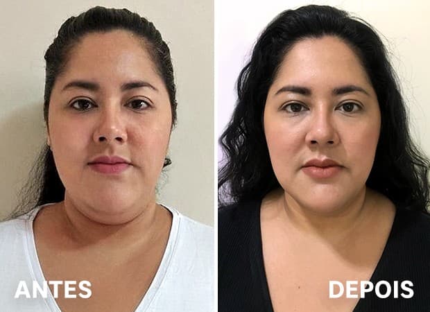 tratamento-papada-antes-depois